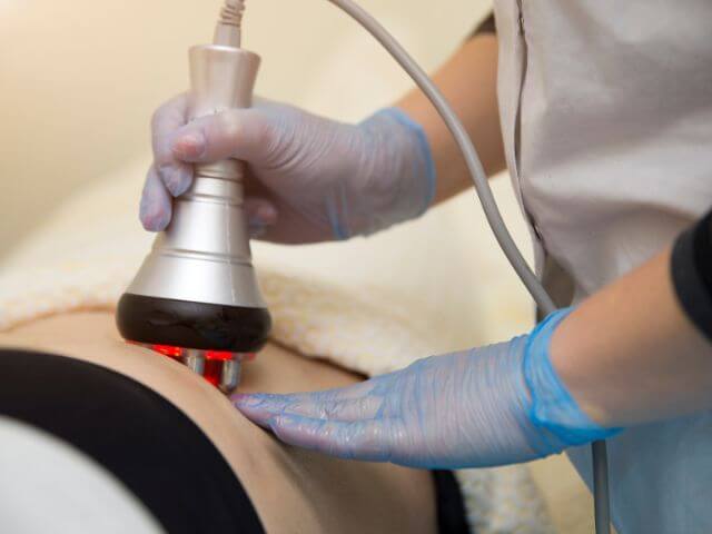 vykonávanie laserovej liposukcie 