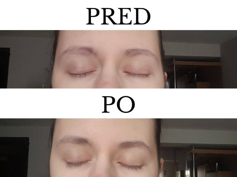 mihalnice a obočie pred a po 35 dňoch používania GigaLash